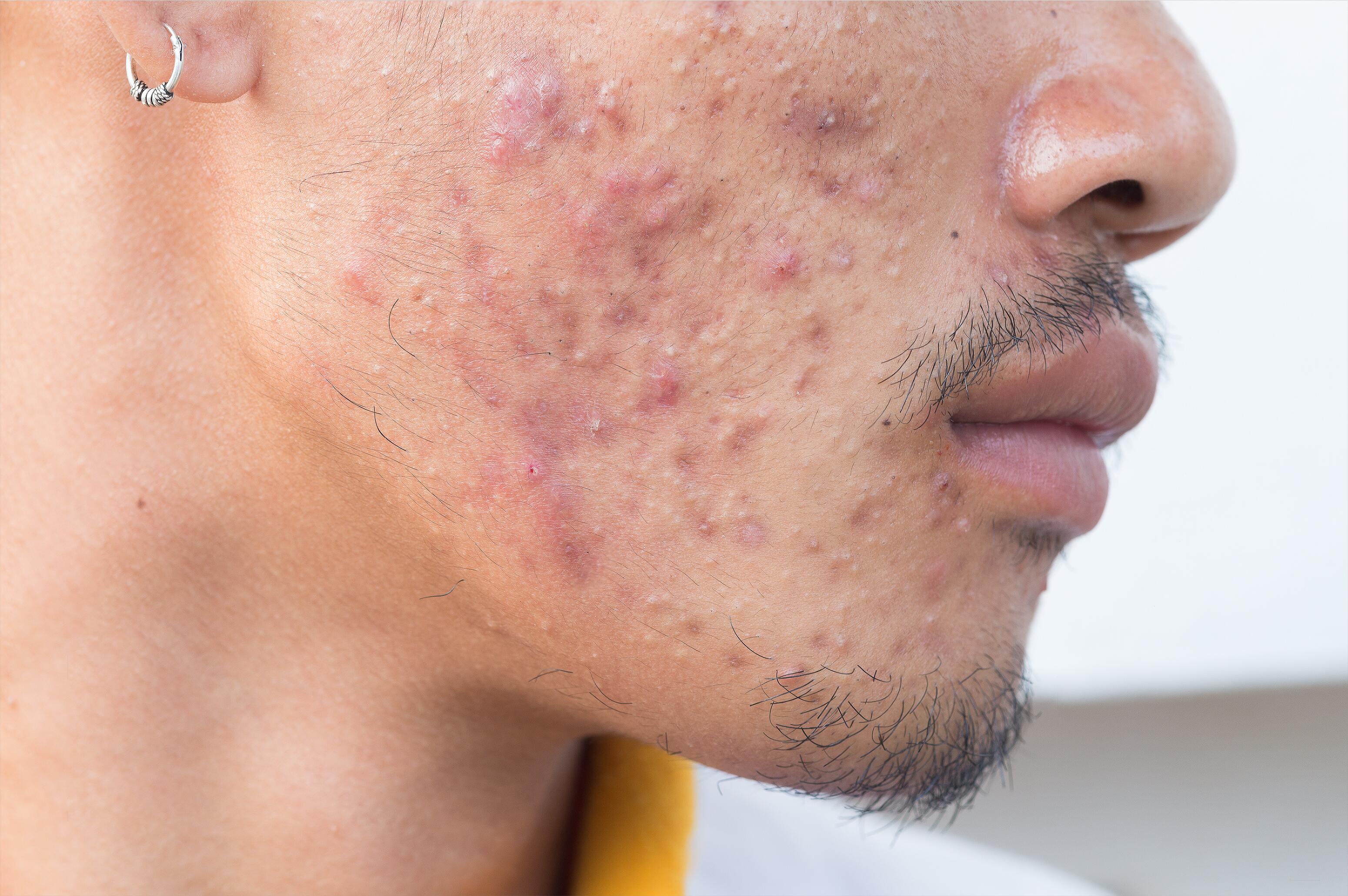 Severe acne spots and scars